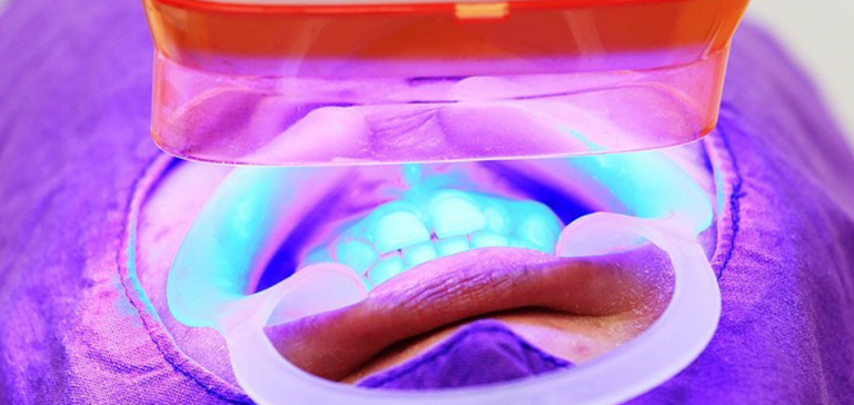 Does Uv Light Whiten Teeth [Does It Really Work?]